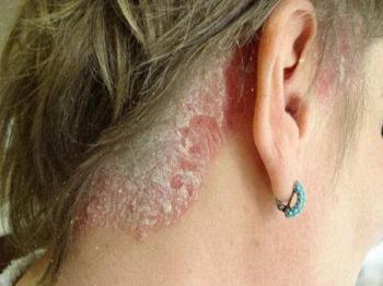 Псориаз волосистой части головы: особенности диагностики и терапии