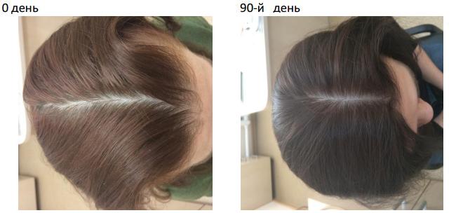 Опыт применения препаратов линии HAIR GENESIS в топической терапии пациентов с различными видами алопеции