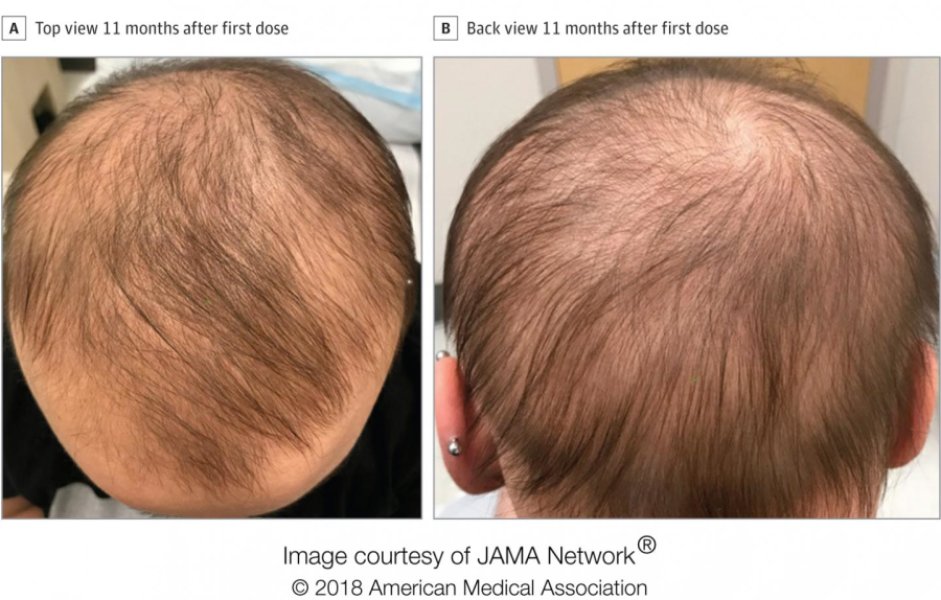 Препарат от экземы восстанавливает рост волос у пациентов с многолетней алопецией :: Новости :: Новости трихологии
