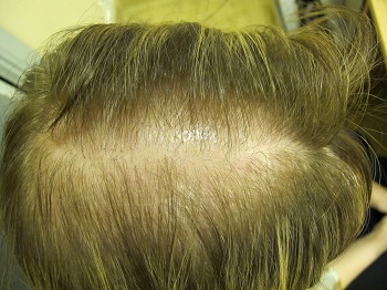Сочетание трихотилломании с первичной патологией волос – андрогенетической алопецией.jpg